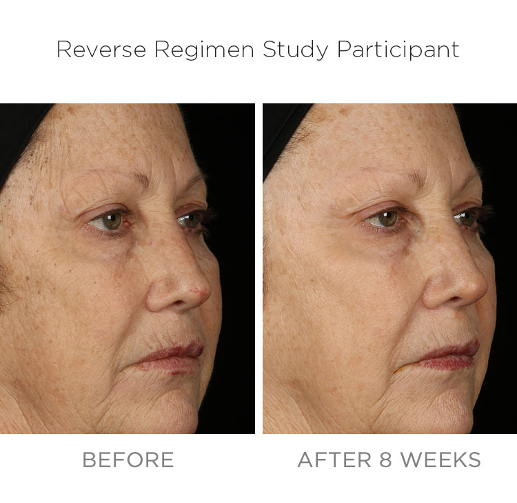 Before Afters Lighten Dark Age Spots Rodan Fields Ca Before Afters Lighten Dark Age Spots Rodan Fields Ca
