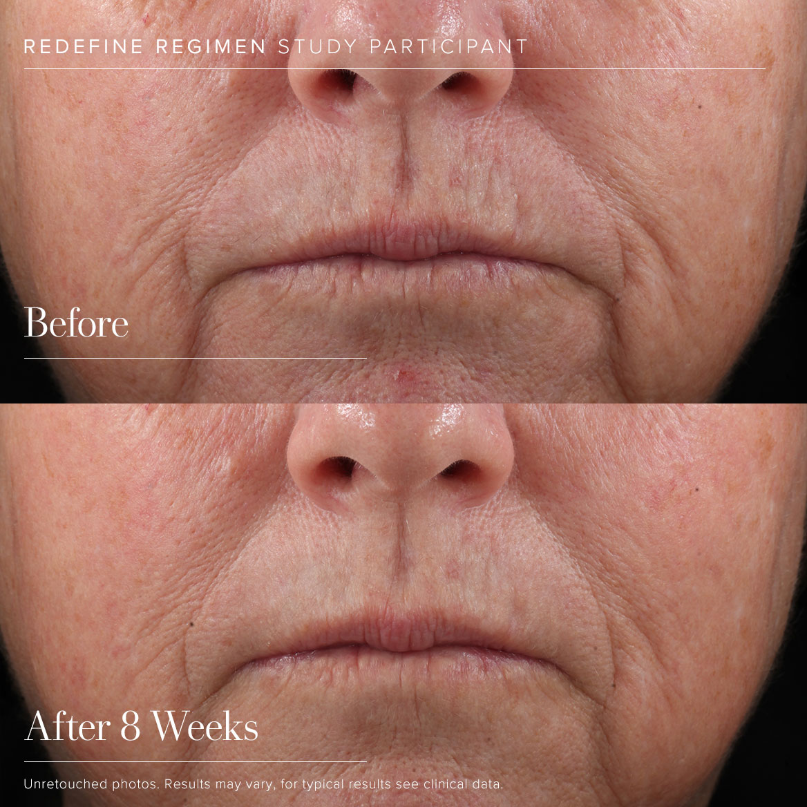REDEFINE Regimen - Before + After
