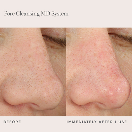 Blackhead Remover Pore Cleansing System Rodan Fields Ca Blackhead Remover Pore Cleansing System Rodan Fields Ca